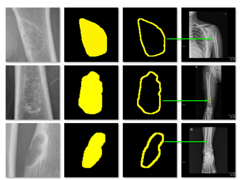 Tracking temporal progression of benign bone tumors through X-ray based detection and segmentation