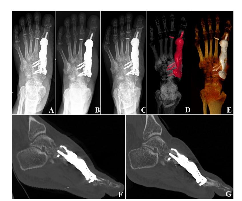 Clinical application research on the titanium metal metatarsal prosthesis designed through FEA and manufactured by 3D printing