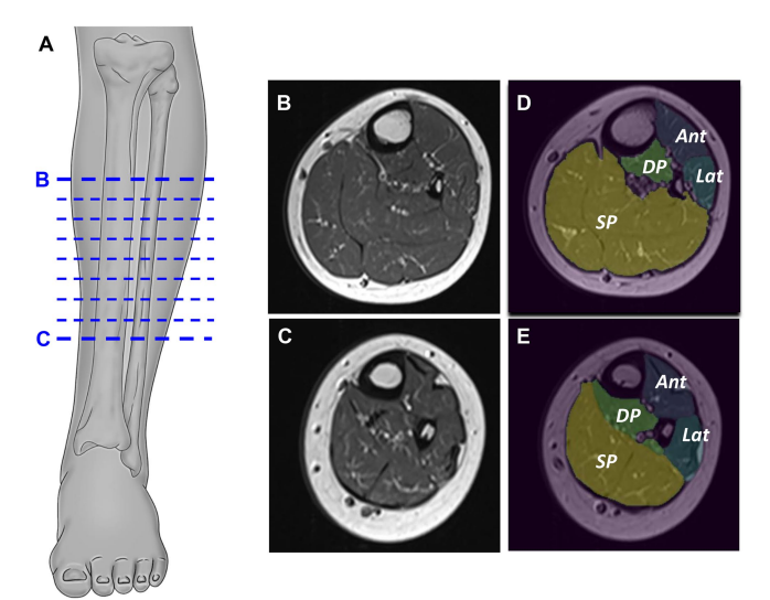 Evaluation of normalized T1 signal intensity obtained using an automated segmentation model in lower leg MRI as a potential imaging biomarker in Charcot– Marie–Tooth disease type 1A